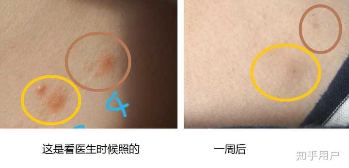 糠秕孢子菌毛囊炎用怎么样才康复 要多久时间才会好的呢? - 知乎
