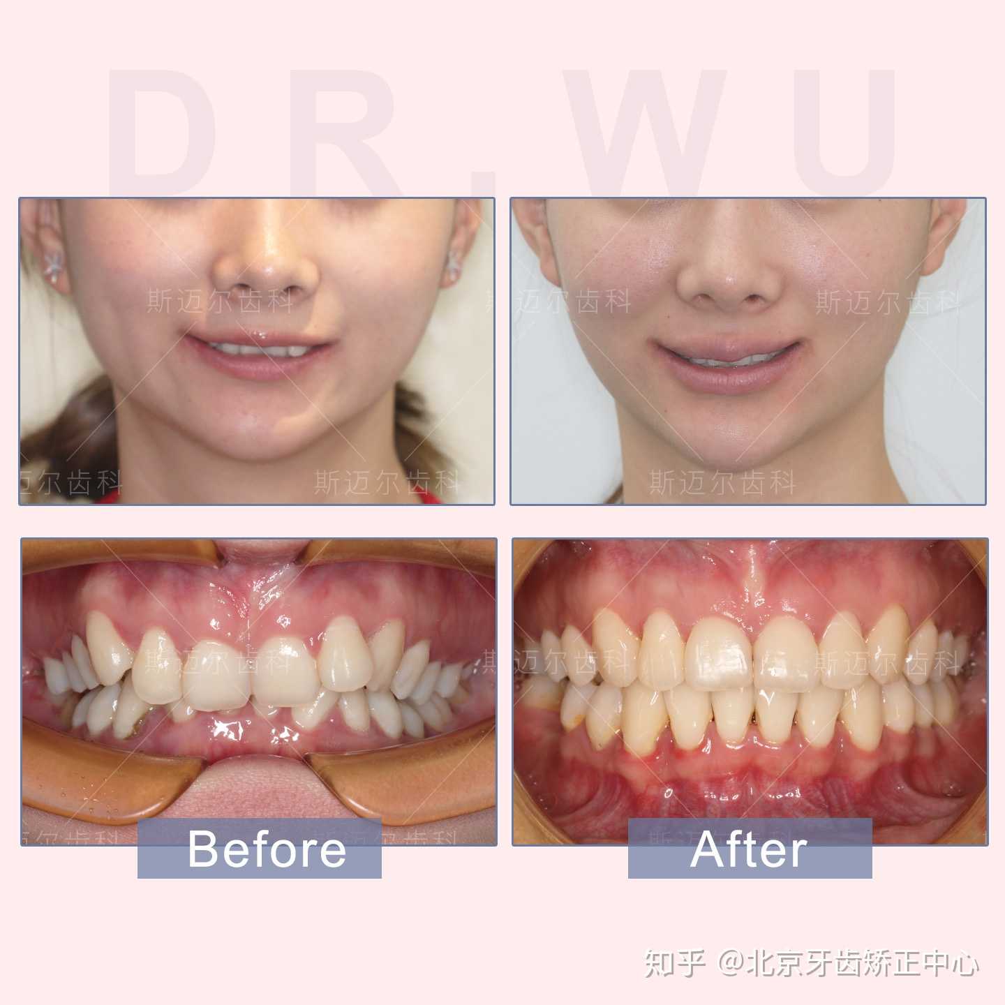 北京牙齿矫正中心 的想法: 患者上牙内扣且盖住下牙,面部表现为嘴瘪