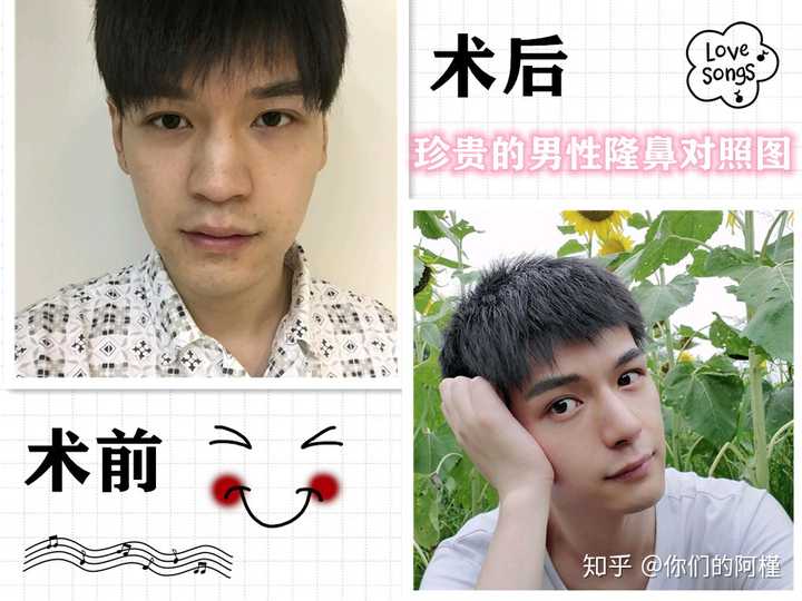 请问有男生做过隆鼻的吗 做完之后感觉咋样 知乎 请问有男生做过隆鼻的吗 做完之后感觉咋样 知乎