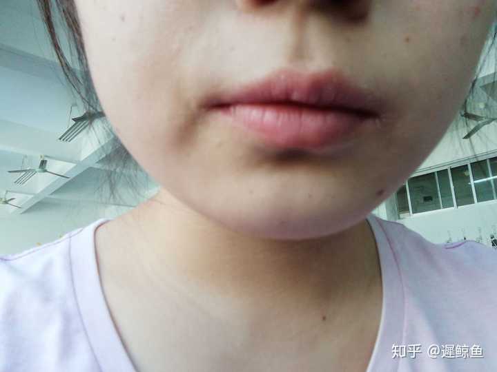 口角炎怎么治疗啊 6 7年了 去医院看看 给开点抹的药 还有维生素 还给打一针 但是现在又犯了 嘴角裂 知乎 口角炎怎么治疗啊 6 7年了 去医院看看 给开点抹的药 还有维生素 还给打一针 但是现在又犯了 嘴角裂 知乎