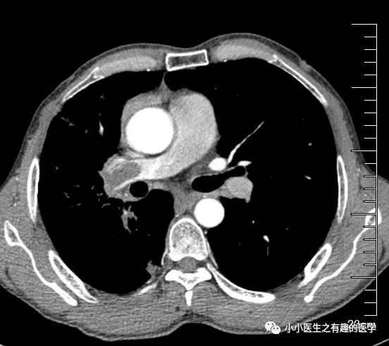 医院的普通ct,普通核磁共振和增强ct增强核磁到底是不是为了创收才让病友去做更贵的增强版? - 知乎