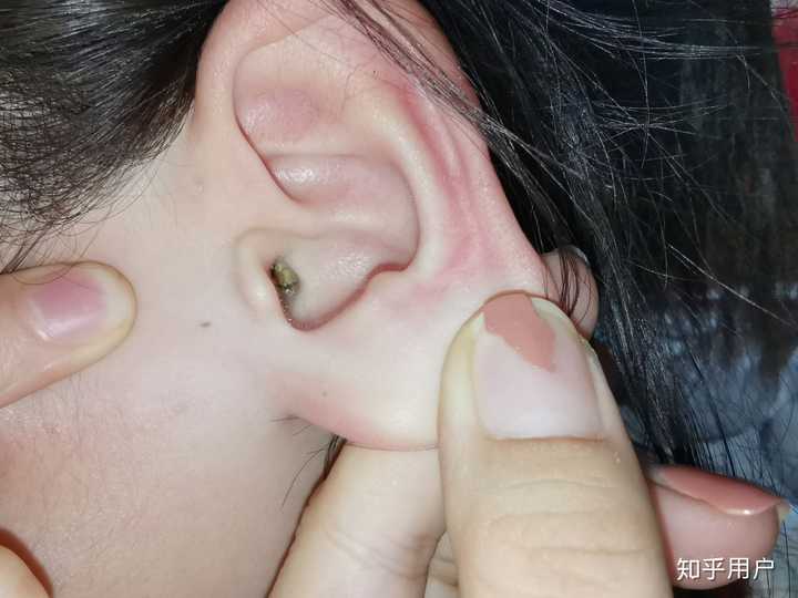 耳朵为什么会有耳屎图片