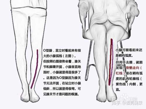 如何矫正罗圈腿 O型腿 知乎