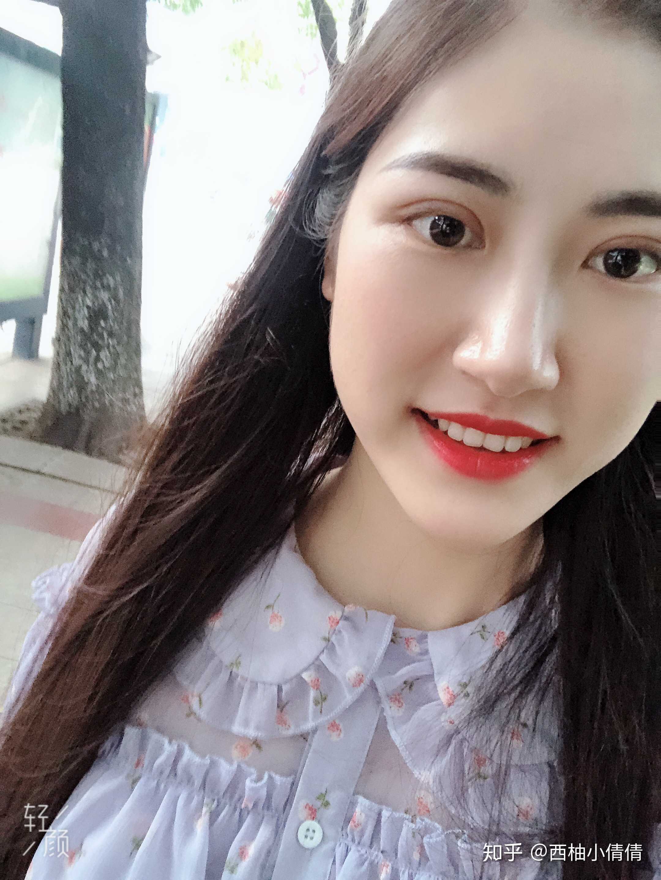 割完双眼皮第二十天