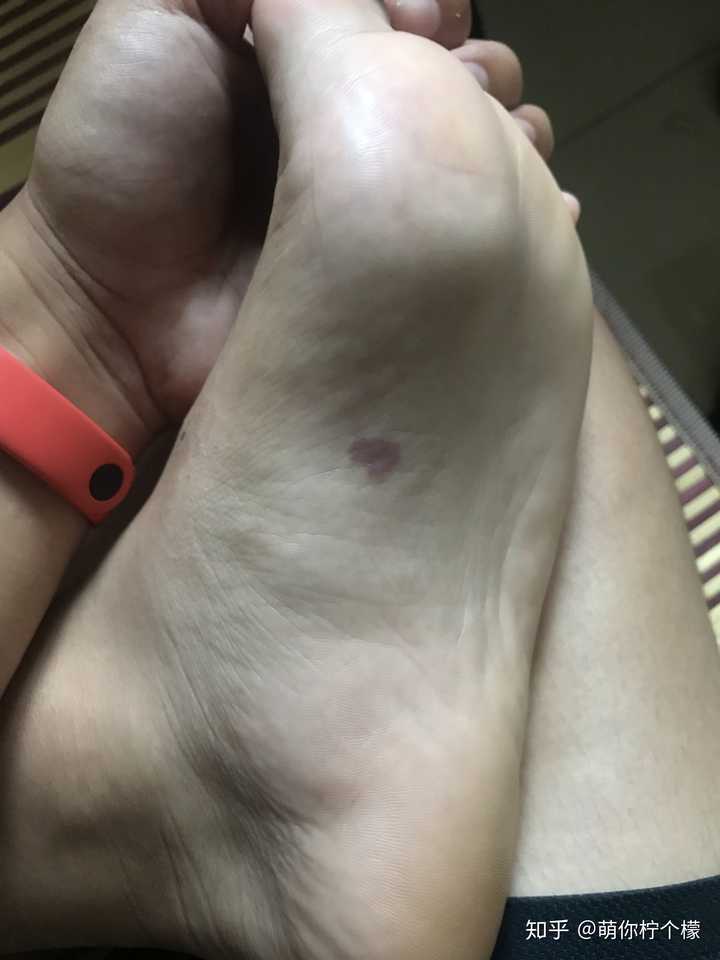 你见过什么特殊的胎记?