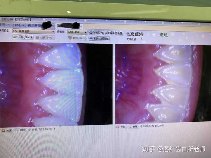 洗牙一般多少钱一次 知乎