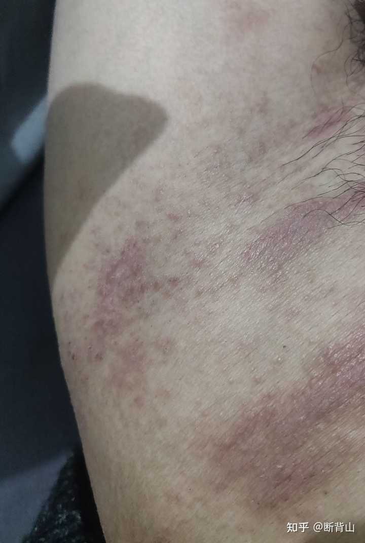 请问我这是股藓还是湿疹？（有图）？ 知乎 