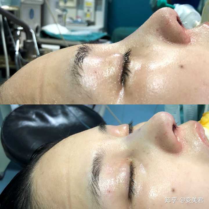 有在上海做过隆鼻的吗 戴传昌怎么样 知乎 有在上海做过隆鼻的吗 戴传昌怎么样 知乎