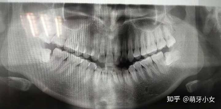 拔完智齿怎么消肿 知乎