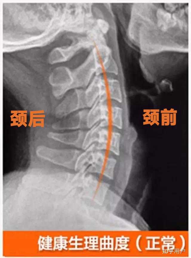 如何区分颈椎反弓图片和正常图片? - 知乎