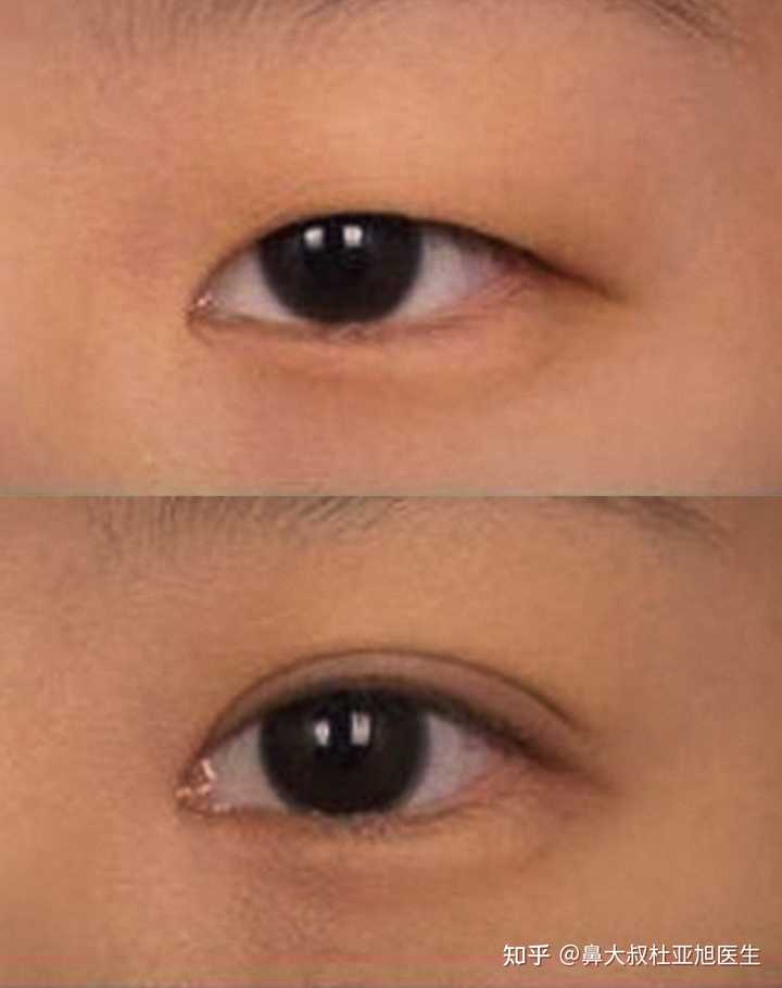 双眼皮是内双怎么办? - 知乎