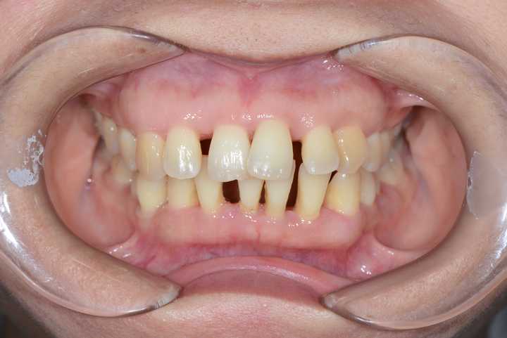 人到中年,矫正牙齿,是对还是错?