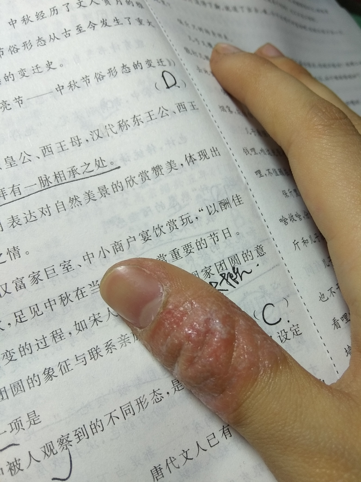 女生喜欢咬手(倒刺和皮),指啃指甲怎么办?