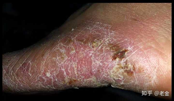 脚气太严重会怎样?