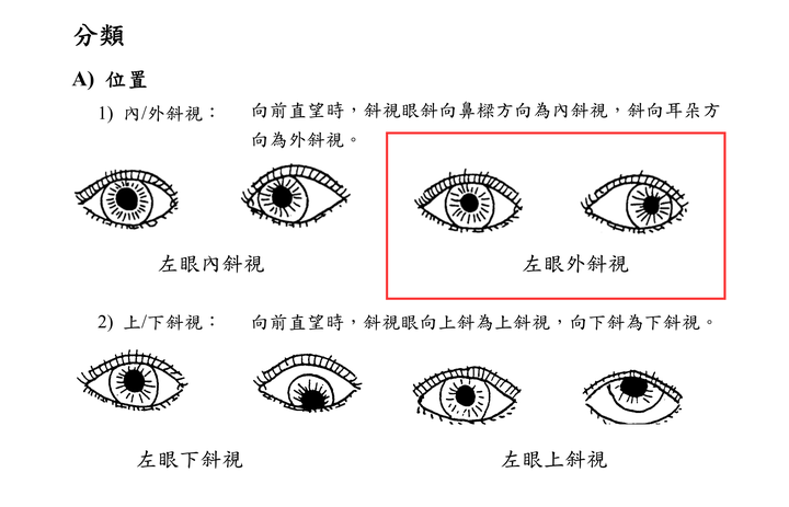 如何糾正斜視?