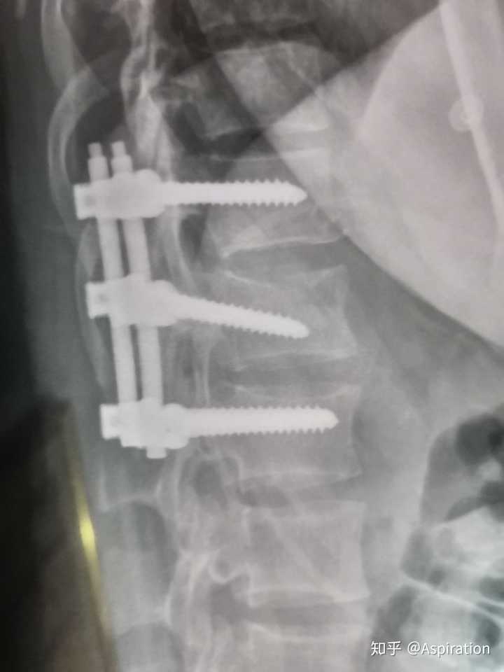 腰椎骨折是怎样的体验 治疗过程是怎样的 多久可以恢复 知乎