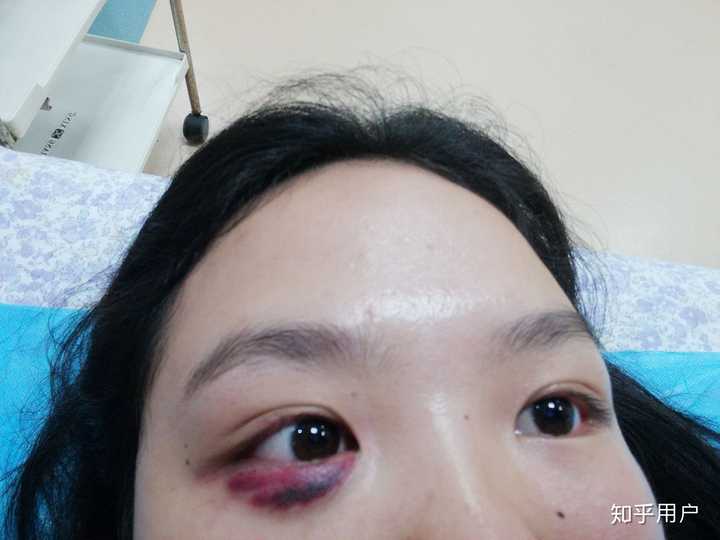 左眼下边血糊糊的这张吧