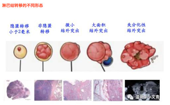 甲状腺癌手术后出现转移的淋巴结怎么办？