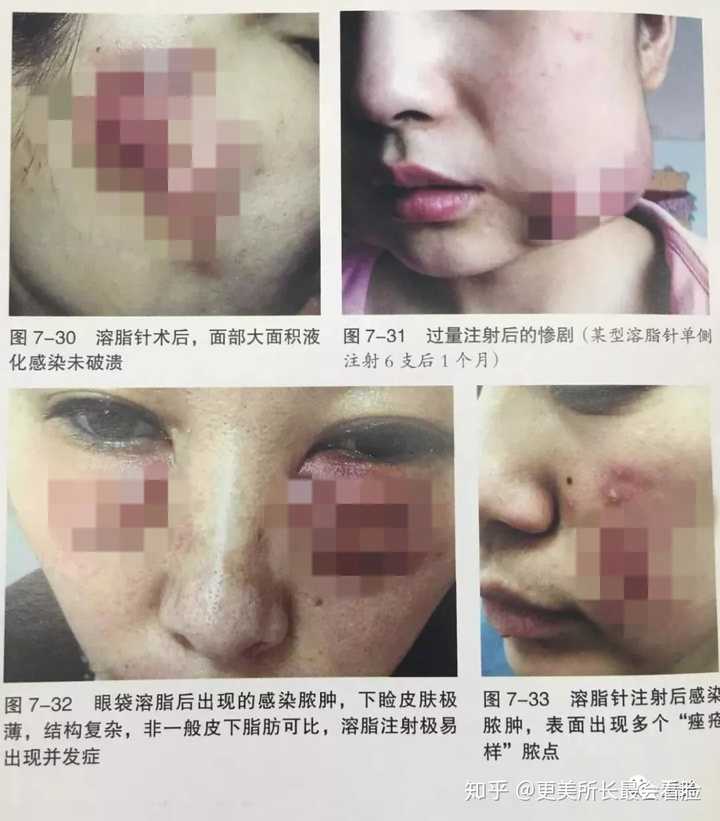 溶脂针有危害吗具体危害有哪些瘦身的原理是什么 知乎