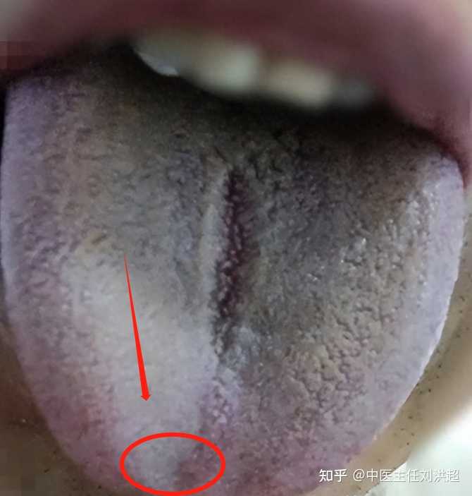 舌头凹陷是怎么回事? - 知乎