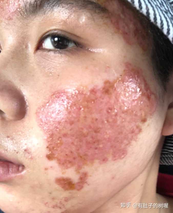 你们的痘坑都是怎么好的.