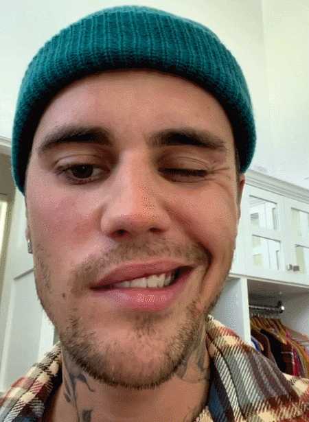 贾斯汀比伯患亨特氏综合征右脸面瘫引网友围观这病有多严重