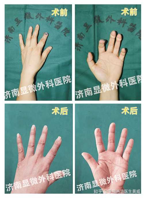 有没有做过残损手指再造的伙伴能给点建议吗