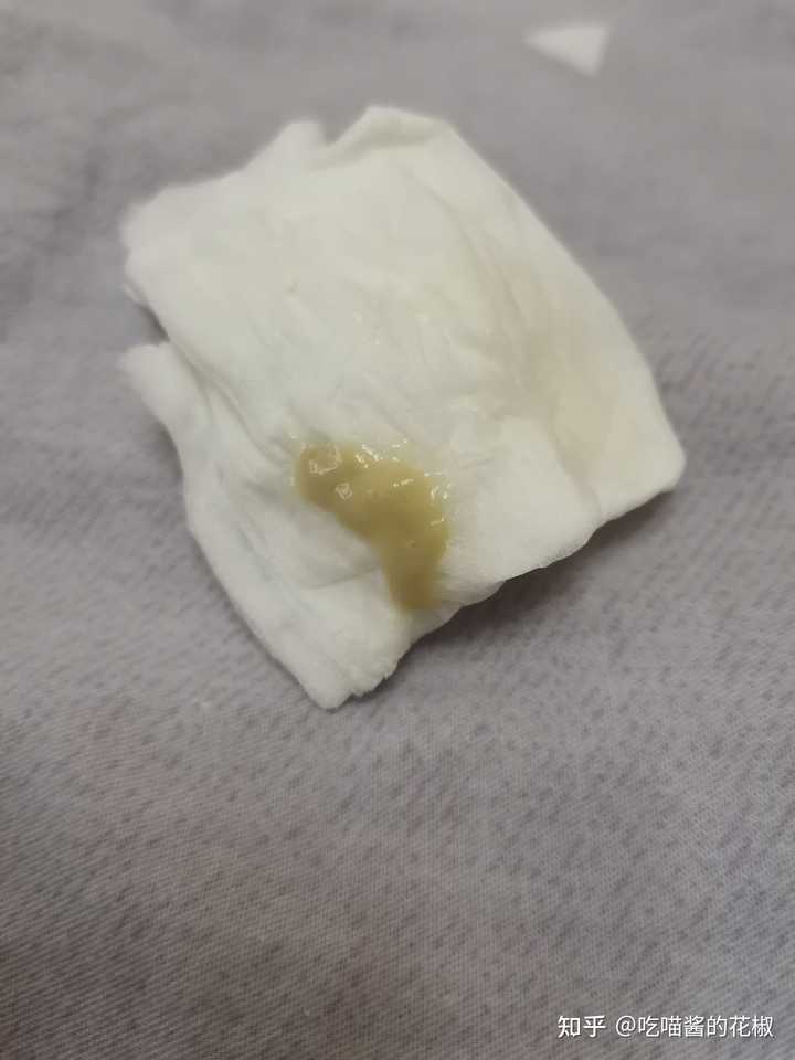 最浓的痰能有多浓? - 知乎