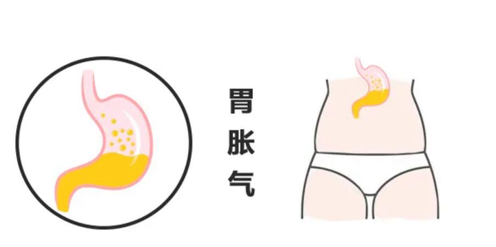 胃胀气怎么办？