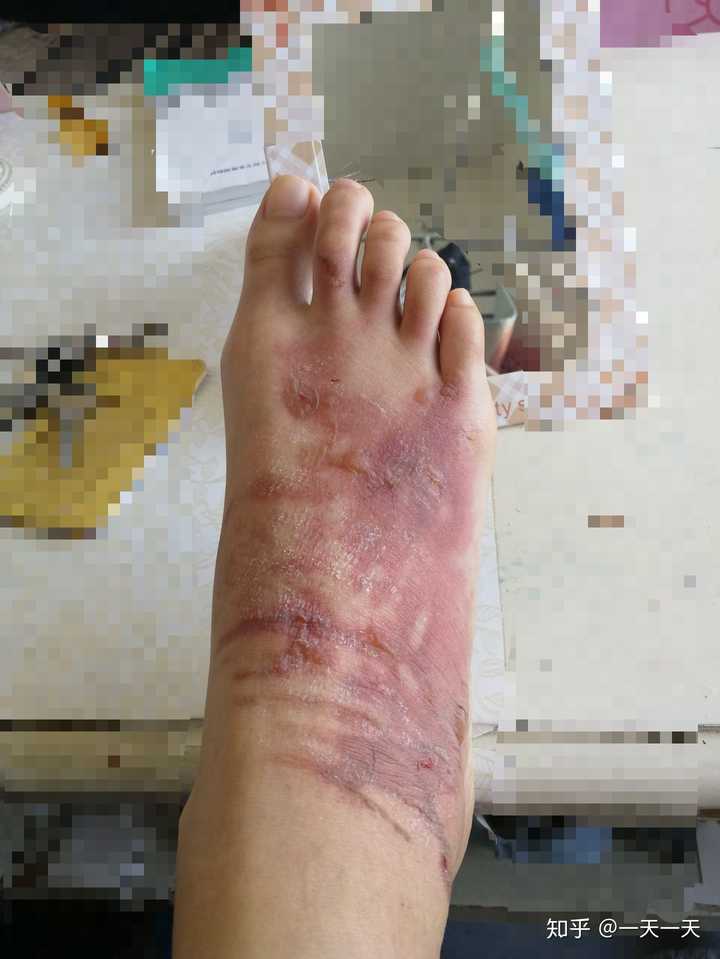 烫伤前后皮肤的具体变化是怎样的 知乎 烫伤前后皮肤的具体变化是怎样的 知乎