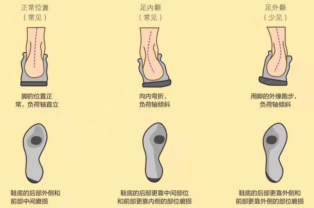 小腿内翻和外翻区别图图片