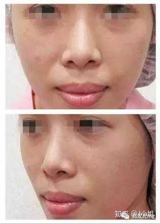 法令纹怎么改善 有什么好的化妆技巧或者面部运动锻炼 知乎