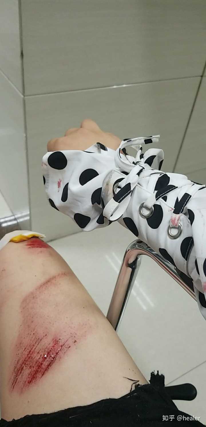 在医院膝盖缝了十针  缝针的时候嘴里咬着东西口红没了 于是缝完针我