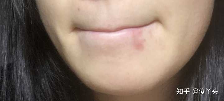 之前上火嘴角起泡好了以后嘴角就留下一块红色的几个月了都不消什么