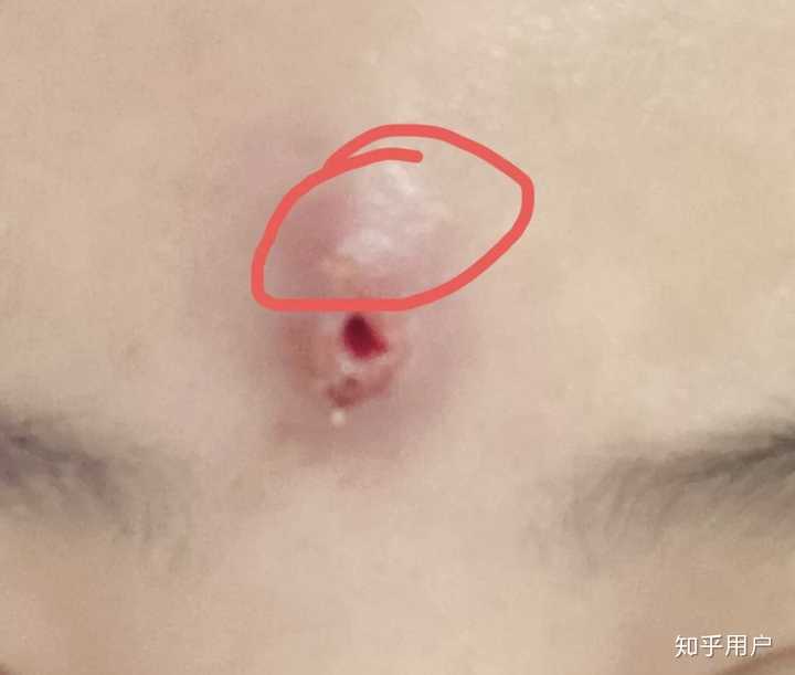 火疖子的病因是什么? - 知乎