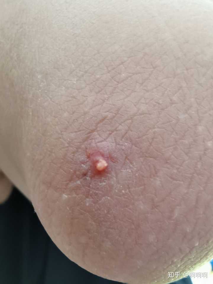 黑头大到直接挤出来是什么感受?