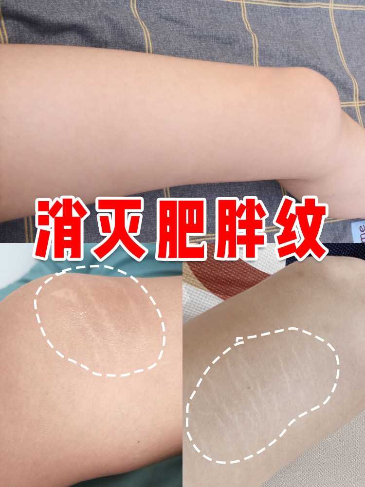 结果瘦下来以后不仅肥胖纹没下去颈纹也跟着更明显了?