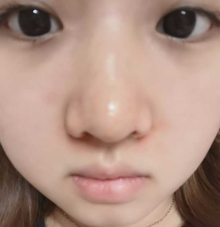 做过缩鼻头鼻翼的小仙女有什么感受吗 知乎 做过缩鼻头鼻翼的小仙女有什么感受吗 知乎