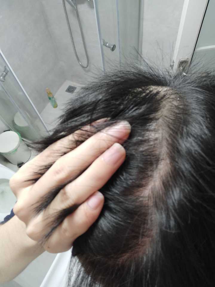 发旋处头发太少了！！！，我是不是要秃了，怎么办啊！？ - 知乎