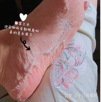 淘宝上很多去角质去死皮老茧的手膜足膜 能蜕掉一层皮 求解释导致蜕皮的成分是什么 对人体有无伤害 知乎 淘宝上很多去角质去死皮老茧的手膜足膜 能蜕掉一层皮 求解释导致蜕皮的成分是什么 对人体有无伤害 知乎
