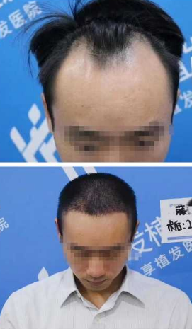 M型脱发该如何拯救 知乎 M型脱发该如何拯救 知乎
