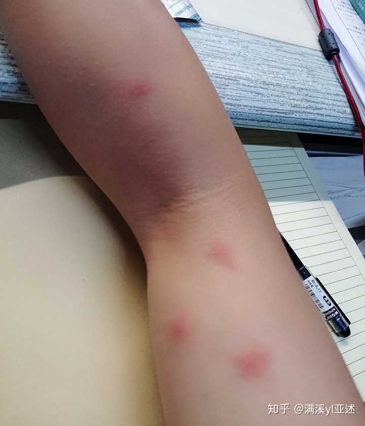 被蚊子咬的红包图片