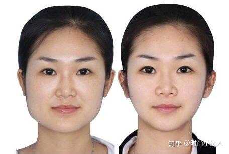 脸胖主要有三种情况