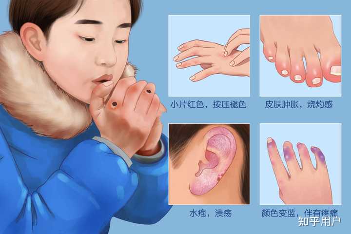 冻伤怎么处理? - 知乎