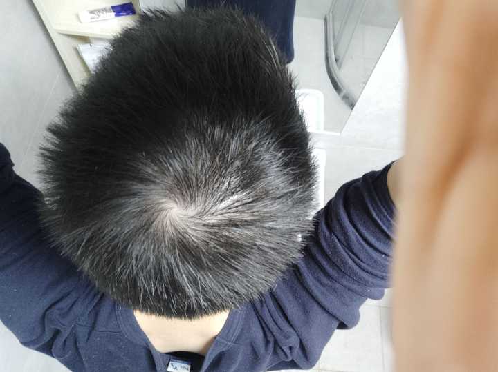 发旋处头发太少了！！！，我是不是要秃了，怎么办啊！？ - 知乎