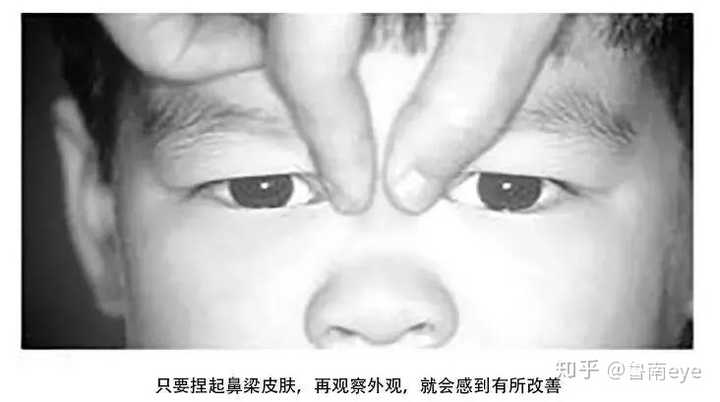 婴儿出现对眼的情况该怎么办？ - 知乎