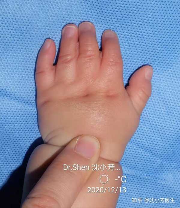 沈小芳医生 的想法: 七个月的孩子波兰综合征我们可以根据皮肤