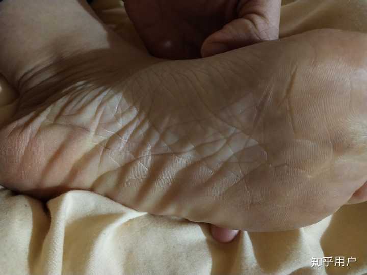 鱼鳞病还有未来吗 知乎