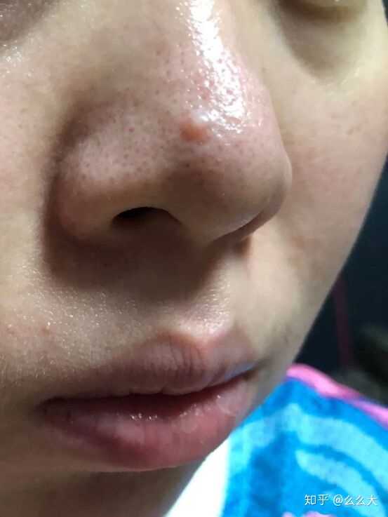鼻子上长痘后留下凸起的包包该怎么消除 知乎 鼻子上长痘后留下凸起的包包该怎么消除 知乎