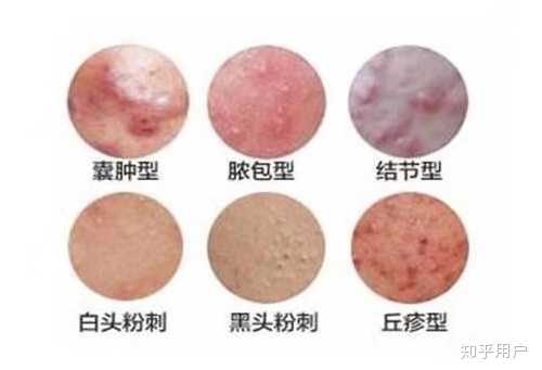 如何正确处理痘痘？ - 知乎